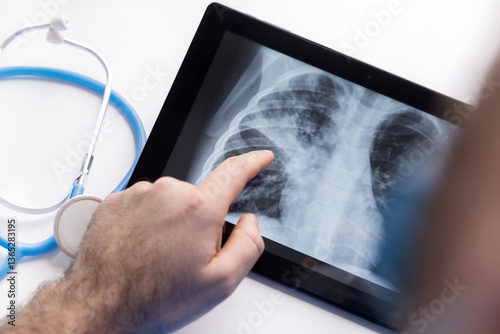 doctor with face surgical mask holding lungs radiography scan showing part infected with bacterial pneumonia.man in blue suit with stethoscope on neck holding tablet pointing with hand.chest x ray