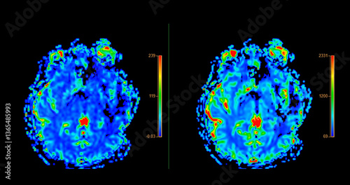 MRI brain perfusion imaging helps assess cerebral blood flow and tissue viability. photo