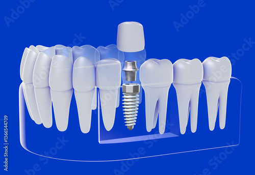 3D illustration of a dental implant in a white and transparent graphic style. Showing the implant separated before placement. Placed in the glass gum on a blue background, showing the interior.