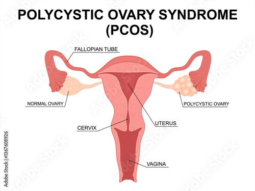 Cross-Section of Female Reproductive System with Polycystic Ovary Syndrome (PCOS). Polycystic ovary and Healthy Ovary. Uterus internal view. 