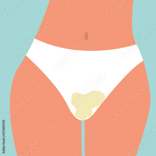 Woman white vaginal discharge on panty. vaginal infection .vector illustration