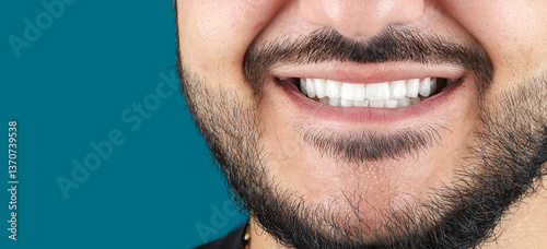 emax ceramic veneers