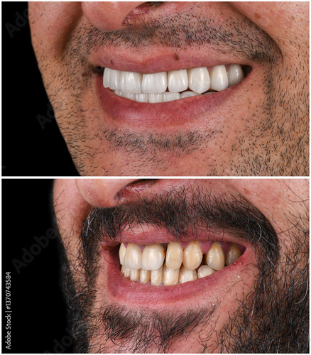 emax ceramic veneers