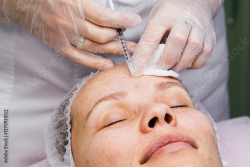 Electrocoagulation and laser cosmelotogy. Dermatologist using a professional electrocautery for removing mole.