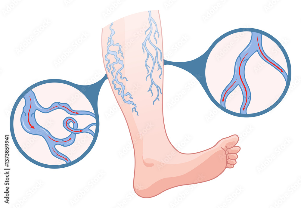 Varicose veins. Blue blood vessel visible through the skin, abnormally swollen leg. Vascular disease diagnostic and treatment. Venous insufficiency medical disease