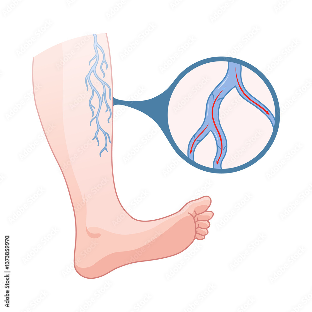 Varicose veins. Blue blood vessel visible through the skin, abnormally swollen leg. Vascular disease diagnostic and treatment. Venous insufficiency medical disease