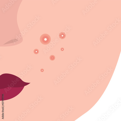 Young girl has skin problems with acne or allergic pimples on her face. Skincare and dermatology concept. Flat style vector illustration.