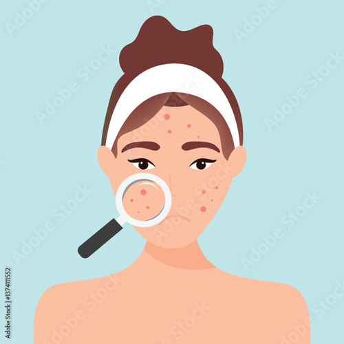 Young girl has skin problems with acne or allergic pimples on her face. Skincare and dermatology concept. Flat style vector illustration.