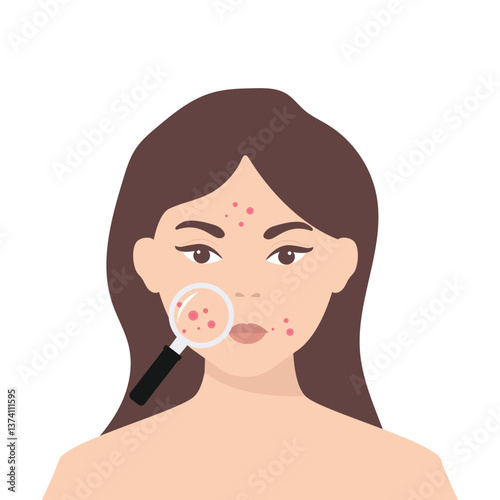 Young girl has skin problems with acne or allergic pimples on her face. Skincare and dermatology concept. Flat style vector illustration.