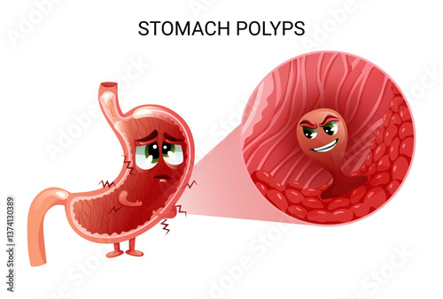 Polyp in stomach under magnification. Sad cartoon stomach character. Vector illustration