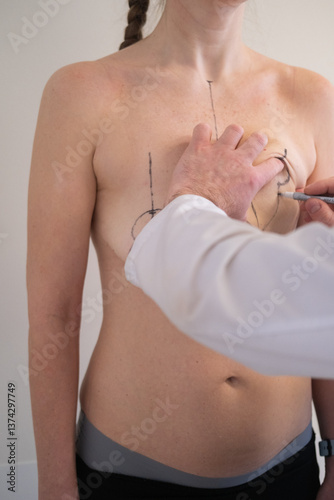 Plastic surgeon marking womans breast with pen before surgery, patient standing topless while doctor draws incision lines on chest, medical aesthetic procedure, medical mammoplasty, mastopexy 