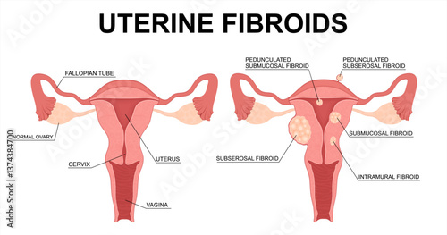 Uterine Fibroids Types. Medical Vector Illustration
