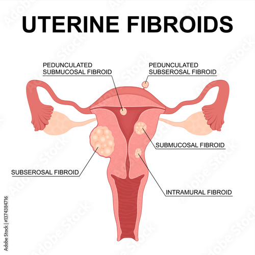 Uterine Fibroids Types. Medical Vector Illustration