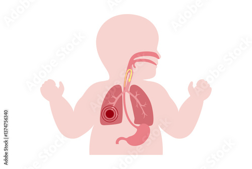 Aspiration pneumonia poster