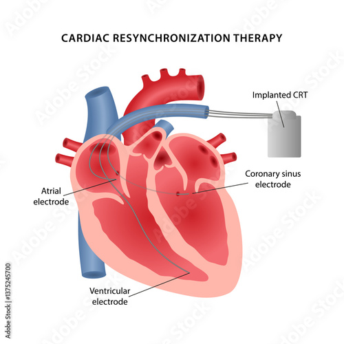 Cardiac resynchronization therapy. Medical illustration of the layout of three electrodes placement diagram for a pacemaker. Vector illustration in a flat style isolated on white background