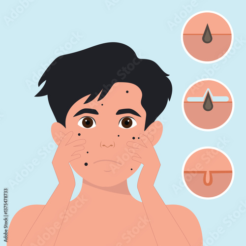 Teenager boy has skin problems with acne or allergic pimples on her face. Skincare and dermatology concept. Flat style vector illustrationv