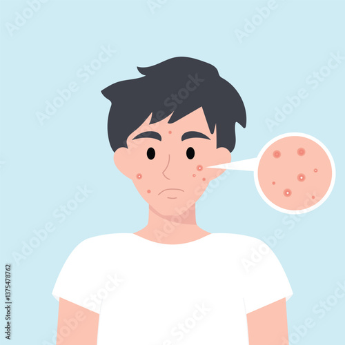 Teenager boy has skin problems with acne or allergic pimples on her face. Skincare and dermatology concept. Flat style vector illustrationv