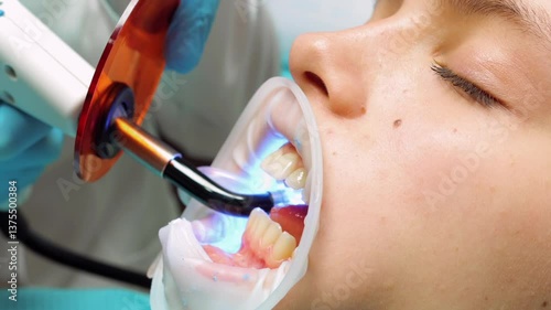 A close-up of a dental procedure where a dentist uses a UV curing light to harden adhesive on a patients teeth, part of the preparation process for applying clear aligners in an orthodontic treatment