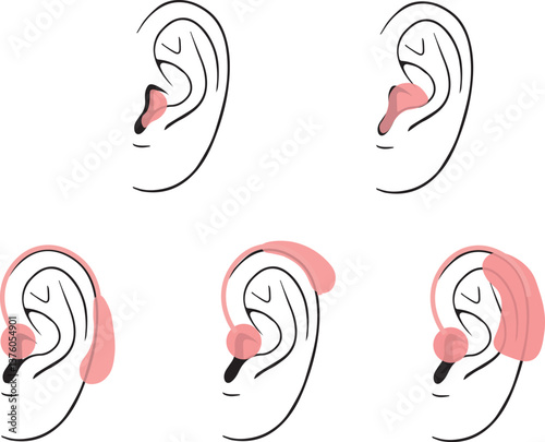 Set of types of different hearing aids
