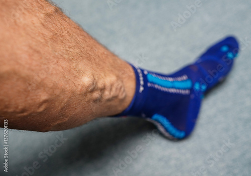 Varicose veins. Phlebology and DVT. Varicose veins on leg of man. Varicosity on legs, spider veins, edema, health illness concept. Phlebeurysm and thrombophlebitis of veins. Phlebology concept.