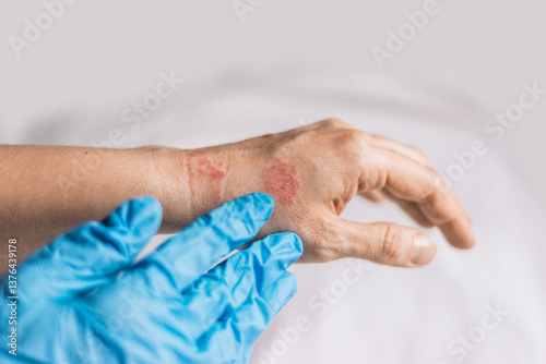 Doctor in blue gloves examines on hands with redness rash. Cause of itchy skin include dermatitis (eczema), dry skin, burned, food, drug allergies, insect bites. Health care concept.