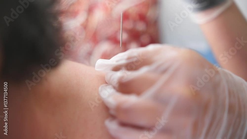 Insertion and handling of a dry needling needle in a patient with muscle pain, health treatment for muscle rehabilitation