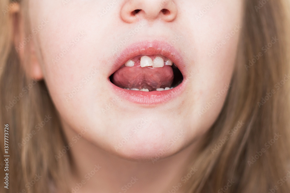 Little child girl moving her milk front tooth with her tongue in open mouth. Little child girl moving her milk front tooth with her tongue in open mouth.