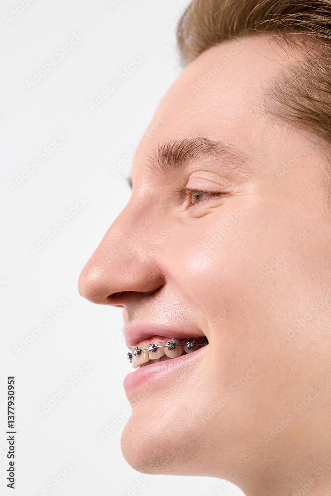 Obraz premium A close-up view of a cheerful young adult with orthodontic braces on their teeth. The persons skin is clear, and they have a content expression on their face, their eyes gently squinting as they smile