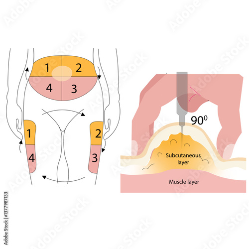 Abdominal and leg insulin injection vector illustration,Insulin Injection Sites Science Design Vector Illustration Diagram
