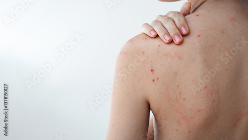 female back and shoulders of a young woman with pimples and acne on skin on a white isolated background. Body of a girl with problematic skin close-up