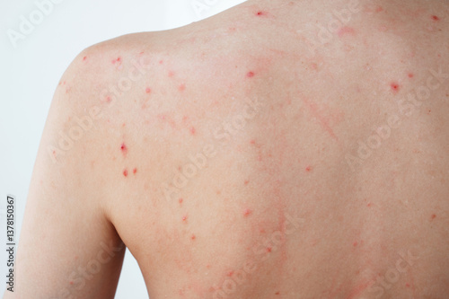 Картината върху платно female back and shoulders of a woman with pimples and acne on skin