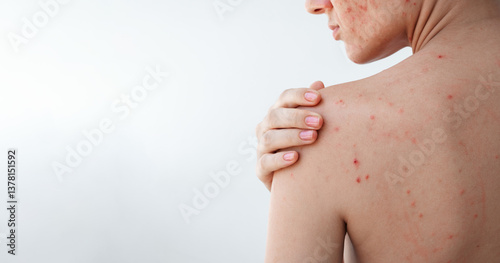 female back of a young woman with acne on skin on a white isolated background. The body of a girl with problematic skin close-up
