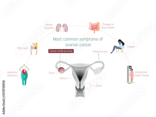 Ovarian cancer symptoms and female reproductive system anatomy