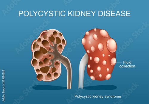 Polycystic kidney disease