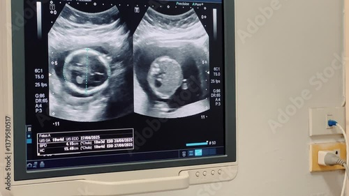2D Ultrasound display of 18 weeks pregnant. Fetus ultrasound image that show important organs.