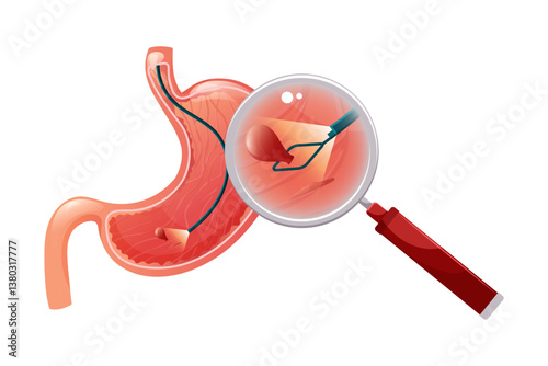 Removal polyp in stomach. Enlarged view of endoscope grasping polyp with loop. Vector medical illustration.