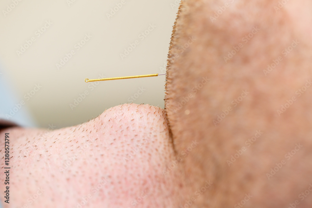 An Intimate CloseUp of an Acupuncture Needle Skillfully Inserted into a Patients Chin for Holistic Therapy and Healing, Showcasing the Art and Science of Restoration and Rejuvenation