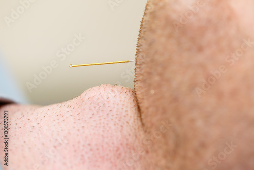 Obraz na płótnie An Intimate CloseUp of an Acupuncture Needle Skillfully Inserted into a Patients Chin for Holistic Therapy and Healing, Showcasing the Art and Science of Restoration and Rejuvenation w salonie