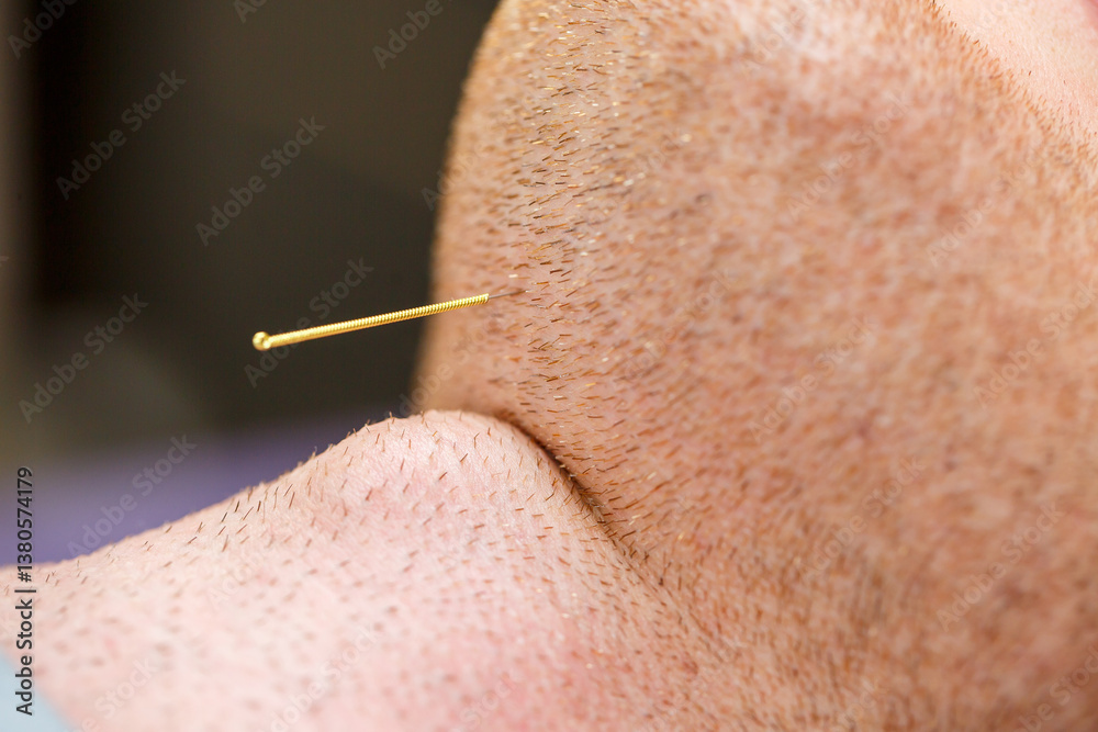 A closeup shot depicting the insertion of an acupuncture needle along the jawline, showcasing its utilization in therapy aimed at providing effective pain relief and promoting overall wellness