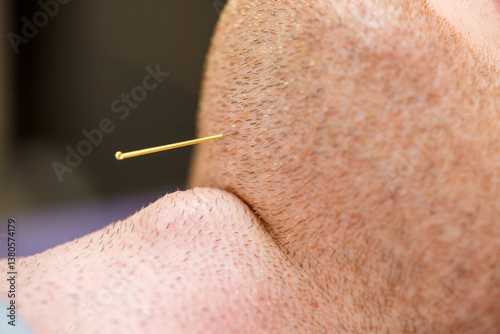 Obraz na płótnie A closeup shot depicting the insertion of an acupuncture needle along the jawline, showcasing its utilization in therapy aimed at providing effective pain relief and promoting overall wellness w salonie