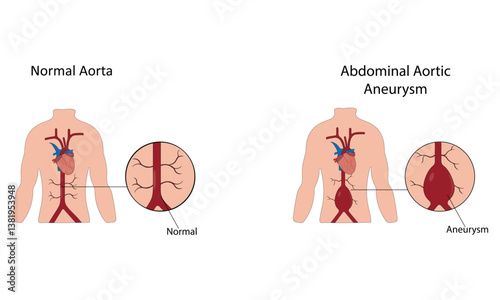 Abdominal aortic aneurysm vector illustration