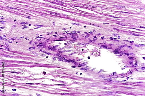Obraz na plátně Microscopic image of a gastrointestinal stromal tumor (GIST), a rare type of cancer that begins in the digestive system