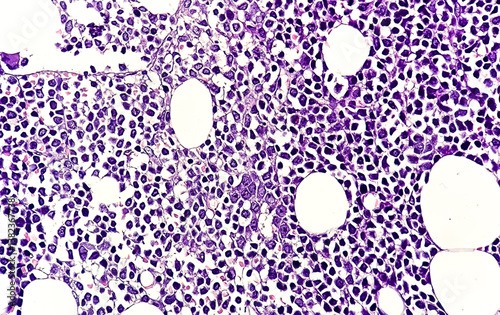 Microscopic image of Trephine Biopsy showing Acute Leukemia, Bone marrow biopsy photo
