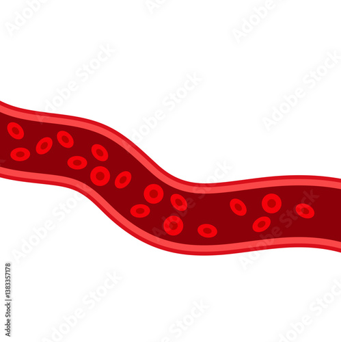 Blood vessel flow and arteriosclerosis. Atherosclerosis Diagram. Vector illustration.
