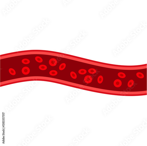 Blood vessel flow and arteriosclerosis. Atherosclerosis Diagram. Vector illustration.
