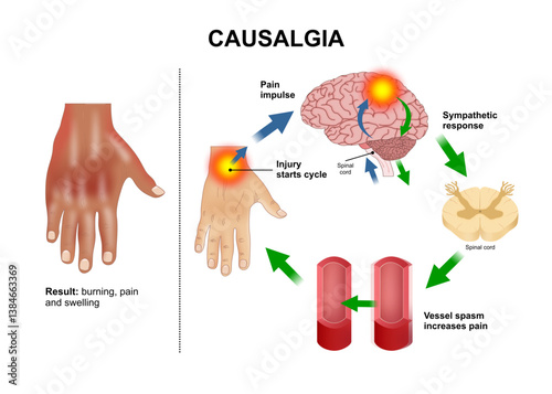 Causalgia (Complex Regional Pain Syndrome Type II) Illustration
