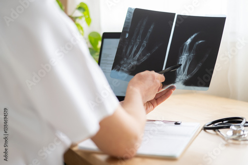 Doctor pointing at a hand x-ray while examining a metacarpal fracture during a medical consultation, offering insights into healthcare, diagnosis, and treatment options
