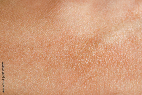 Texture of skin with scar as background, closeup