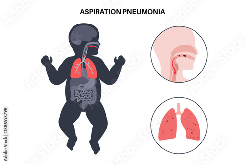Aspiration pneumonia poster