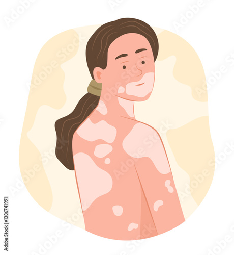 Young Woman with Vitiligo Disease on Body Skin for Dermatological Symptom Concept Illustration Clip Art